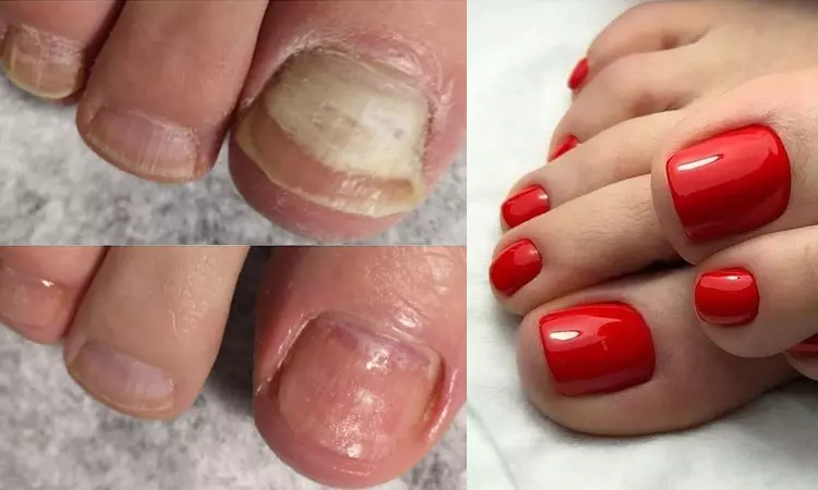 Лечение онихолизиса после гель-лака